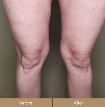 before-after-knees-after