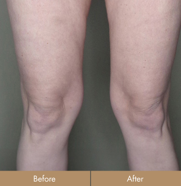 before-after-knees-before