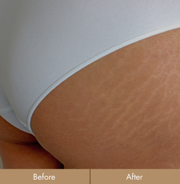 before-after-stretch-marks-before-2